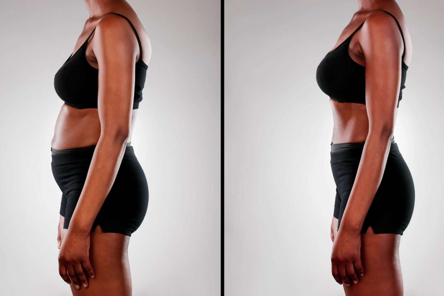 Transformation: African American Woman's Before and After Weight Loss Journey with Liposuction and Abdominoplasty Surgery